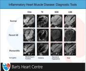Cardiomyopathy UK