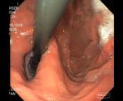 SAGES - Minimally Invasive Surgery Videos