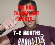 International Hair Loss Journey