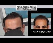 Feller and Bloxham Hair Transplants