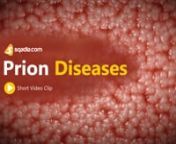 Several diseases fall under the category of prion diseases. Prion diseases occur when normal prion protein becomes abnormal and clump in the brain, causing brain damage. nn-------------------------------------------------------------nLecture Duration - 00:41:44nRelease Date - March 2020nnWatch complete lecture on sqadia.com -nhttps://www.sqadia.com/programs/prion-diseasesn-------------------------------------------------------------nnIn this short Prion Diseases Animation, medical students are i