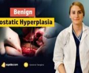 Learn General Surgery with Us! - Watch complete lecture on sqadia.com nhttps://www.sqadia.com/programs/benign-prostatic-hyperplasiannBenign Prostatic Hyperplasia is the common condition of men. In this V-Learning™, medical students will get to know about the surgical anatomy of prostate and prostate Pathology. nnLikewise, information is provided about symptoms of lower urinary tract bladder and outflow obstruction causes. Moreover, surgical procedure i.e. Prostatectomy is discussed along with