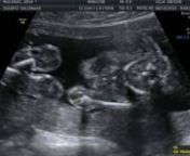 Due October 29 2013, the second ultrasound recorded at 20 weeks and 2 days.... We meet our little baby girl!sooo cute... as she waves hello to us ;)