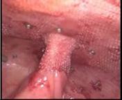 This video shows a laparoscopic method for the mesh repair of a parastomal hernia. The video is associated with a Video vignette in press with Colorectal Disease that will be published online soon (http://onlinelibrary.wiley.com/journal/10.1111/(ISSN)1463-1318).nnPara-stomal hernia is a common complication of stoma formation with a documented incidence of up to 55%. Several management options are available for hernia repair including relocation or fascial repair with or without a mesh and can be