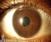 A short microscope video showing KP (keratic precipitates) that have formed on the back surface of the cornea of the eye.