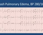 Summary By: Steve SmithnnLast year at SMACC, I talked on NonSTEMI that need the cath lab now and showed many ECGs which represent acute coronary occlusion (Myocardial Infactions) but present on the ECG as very subtle findings (http://hqmeded-ecg.blogspot.com/search?q=subtle), particularly as subtle ST segment elevation that does not meet “STEMI” criteria and is diagnosed as NonSTEMI.nnThis year, I build on that idea and challenge the whole idea of a dichotomy between STEMI and NonSTEMI. Thes