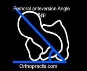 Femoral anteversion is defined by the angle of the femoral neck in relation to the femoral shaft in the coronal plane. Femoral rotational malalignment is associated with pain and functional disability, hip impingement and instability. Measurement of anteversion of the femoral neck is an important component of surgical planning, for femoral osteotomy in patients with cerebral palsy or developmental dysplasia of the hip andtotal hip replacement surgery. In-toeing gait due to excessive femoral a