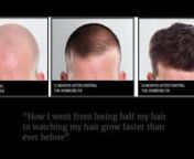 The True Cause of Hair Loss Revealed: And The New Breakthrough That’s Solving It.nnFor more details visit this page:nnhttp://www.nicehair.org/true-cause-hair-loss-revealed-new-breakthrough-thats-solving/