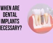 Implants are a natural-looking replacement for missing teeth. A dental implant is a restorative procedure required when you have missing teeth or loose dentures. If you do not want to wear removable dentures, as the wearer complains a lot, &amp; want a long-lasting solution for your missing teeth get dental implants in Orem, UT. If you have had a tooth extraction due to infection it is time to get a permanent solution of dental implants. With a 95% of success rate implats till now is the number