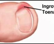 Ingrown Toenails - Podiatrist, foot Doctor of Podiatric Medicine, Foot Specialist, Toronto, ON nnPodiatrist Sheldon Nadal discusses the symptoms, causes and treatments for Ingrown Toenailsnhttp://www.footcare.netnPainless Toenail Surgery:nIt is possible to get permanent relief from ingrown toenails in my Toronto podiatry office with a minor surgical procedure. The procedure is performed painlessly under local anesthetic - only your toe is frozen. Justthe painful ingowing side of the nail is re