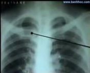 X Quang trong chẩn đoán bệnh phổin1. Các phương pháp X quang:n1.1. Chiếu phổi: n Quan sát phổi khi đang hoạt động. Thấy rõ cử động của phổi, vòm hoành. Thấy sự thay đổi của tổn thương khi thay đổi tư thế. Có thể chiếu thẳng, nghiêng, chếch. Khi quan sát có thể cho BN nghiêng người (TDMP), ưỡn, ngửa hoặc lắc (TK+ TDMP)… hoặc cho BN ho, hít sâu, nín thở…nNhược điểm: bỏ sót tổn thương nh