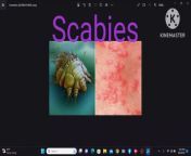 Scabies skin disease /scabies ka ilaj/scabies home treatment/ scabies treatment/scabies lotion/ Part ;2 health everywhere&#60;br/&#62;#scabies #scabiestreatment#skinallergy &#60;br/&#62;quaries&#60;br/&#62;scabies&#60;br/&#62;scabies home treatment&#60;br/&#62;scabies home remedy&#60;br/&#62;health everywhere&#60;br/&#62;home remedy&#60;br/&#62;scabies in india&#60;br/&#62;scabies in pakistan &#60;br/&#62;scabies in hyderabad&#60;br/&#62;scabies in karachi&#60;br/&#62;karachi scabies disease&#60;br/&#62;scabies in mumbia&#60;br/&#62;scabies in delhi&#60;br/&#62;scabies cause&#60;br/&#62;scabies symptoms&#60;br/&#62;health everywhere&#60;br/&#62;mite&#60;br/&#62;Allergy&#60;br/&#62;scabies treatment&#60;br/&#62;scabies under microscope&#60;br/&#62;scabies lotion&#60;br/&#62;permethrin lotion&#60;br/&#62;dr sandesh gupta&#60;br/&#62;scabion lotion&#60;br/&#62;scabies in girl&#60;br/&#62;scabies in lady&#60;br/&#62;scabies in child&#60;br/&#62;scabies in children&#60;br/&#62;scabies 2 month childscabies&#60;br/&#62;scabies rash&#60;br/&#62;scabies treatment&#60;br/&#62;scabies symptoms&#60;br/&#62;how do you get scabies&#60;br/&#62;pictures of scabies&#60;br/&#62;what causes scabies&#60;br/&#62;scabies rash photos&#60;br/&#62;scabies bites&#60;br/&#62;what can be mistaken for scabies&#60;br/&#62;is scabies contagious&#60;br/&#62;how to get rid of scabies&#60;br/&#62;scabies at home treatment&#60;br/&#62;scabies after treatment&#60;br/&#62;scabies armpit&#60;br/&#62;scabies and pregnancy&#60;br/&#62;scabies and dogs&#60;br/&#62;scabies and bed bugs&#60;br/&#62;scabies appearance&#60;br/&#62;scabies all over body&#60;br/&#62;scabies are caused by&#60;br/&#62;scabies ankles&#60;br/&#62;are scabies contagious&#60;br/&#62;adhesive tape test for scabies&#60;br/&#62;at home scabies treatment&#60;br/&#62;are scabies common&#60;br/&#62;are scabies an std&#60;br/&#62;a picture of scabies&#60;br/&#62;are scabies curable&#60;br/&#62;antiparasitic for scabies&#60;br/&#62;about scabies mite&#60;br/&#62;about scabies disease&#60;br/&#62;scabies bumps&#60;br/&#62;scabies blisters&#60;br/&#62;scabies between fingers&#60;br/&#62;scabies bites on humans&#60;br/&#62;scabies body lice bites&#60;br/&#62;scabies black skin&#60;br/&#62;scabies bites treatment&#60;br/&#62;scabies baby&#60;br/&#62;benzyl benzoate for scabies&#60;br/&#62;bed bugs vs scabies&#60;br/&#62;best tablet for scabies&#60;br/&#62;best injection for scabies&#60;br/&#62;best treatment for scabies&#60;br/&#62;burrow how to identify scabies&#60;br/&#62;best sulfur ointment for scabies&#60;br/&#62;bed bug bites vs scabies&#60;br/&#62;body lice vs scabies&#60;br/&#62;benzyl benzoate scabies effectiveness&#60;br/&#62;scabies contagious&#60;br/&#62;scabies cream&#60;br/&#62;scabies cause&#60;br/&#62;scabies cure&#60;br/&#62;scabies cat&#60;br/&#62;scabies cdc&#60;br/&#62;scabies contact precautions&#60;br/&#62;scabies contagious period&#60;br/&#62;scabies cream over the counter&#60;br/&#62;scabies crusted&#60;br/&#62;crusted scabies&#60;br/&#62;can scabies kill you&#60;br/&#62;can dettol kill scabies&#60;br/&#62;can you have scabies for years&#60;br/&#62;causes of scabies&#60;br/&#62;crusted scabies pictures&#60;br/&#62;can dogs get scabies&#60;br/&#62;can you see scabies&#60;br/&#62;cream for scabies&#60;br/&#62;can you get scabies from a dog&#60;br/&#62;scabies definition&#60;br/&#62;scabies doctor&#60;br/&#62;scabies dog&#60;br/&#62;scabies diagnosis&#60;br/&#62;scabies disease&#60;br/&#62;scabies dry cleaning&#60;br/&#62;scabies dog treatment&#60;br/&#62;scabies description&#60;br/&#62;scabies differential diagnosis&#60;br/&#62;scabies distribution&#60;br/&#62;does vaseline kill scabies&#60;br/&#62;dead scabies pictures&#60;br/&#62;dog scabies&#60;br/&#62;do i have scabies&#60;br/&#62;does scabies spread&#60;br/&#62;drugs for scabies&#60;br/&#62;dose of ivermectin in scabies&#60;br/&#62;diagnosis of scabies&#60;br/&#62;scabies en español&#60;br/&#62;scabies eggs&#60;br/&#62;scabies exposure&#60;br/&#62;scabies early stage&#60;br/&#62;scabies eggs on skin&#60;br/&#62;scabies exposure icd 10&#60;br/&#62;scabies early&#60;br/&#62;scabies eggs under microscope&#60;br/&#62;scabies exposure treatment&#60;br/&#62;early scabies&#60;br/&#62;early how to identify scabies&#60;br/&#62;eczema or scabies&#60;br/&#62;early stage scabies in dogs&#60;br/&#62;what is scabies&#60;br/&#62;exposure to scabies&#60;br/&#62;early signs of scabies in humans&#60;br/&#62;effects of scabies&#60;br/&#62;scabies face&#60;br/&#62;scabies from cats&#60;br/&#62;scabies feet&#60;br/&#62;scabies from hotel&#60;br/&#62;scabies from cats to humans&#60;br/&#62;scabies fever&#60;br/&#62;first signs o