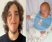 A mum who was told she was “cruel” for having her son after he was born with a rare severe cleft lip says it has never held him back.&#60;br/&#62;&#60;br/&#62;Zac Coates, now 18, was born with Tessier cleft lip and palate – a condition which is caused by facial tissues not joining up properly during development.&#60;br/&#62;&#60;br/&#62;It left Zac with severe facial disfigurement on his ride side and he had no eye lid which left him blind in his right eye.&#60;br/&#62;&#60;br/&#62;Mum, Joanne Lythgoe-Frank, 58, was “shocked” when she first saw her son but raised him to accept his differences.&#60;br/&#62;&#60;br/&#62;Zac has undergone 16 surgeries to help restructure his face and is now a happy and healthy 18-year-old who is hoping to go to university to study film production in September.&#60;br/&#62;&#60;br/&#62;Zac, who lived in Cyprus for 17 years, has dealt with stares and comments such being called a “monster” – but he hasn’t left his difference hold him back.&#60;br/&#62;&#60;br/&#62;Joanne, a part-time receptionist, living in Faringdon, Oxfordshire, said: “My initial reaction was shock at the extent of it. &#60;br/&#62;&#60;br/&#62;“It was different to what I expected – a lot more severe.&#60;br/&#62;&#60;br/&#62;“I’ve never hidden Zac away to be an over protective mother.&#60;br/&#62;&#60;br/&#62;“I tried to instil in Zac – ‘you are different but to embrace it and be proud of your differences’.&#60;br/&#62;&#60;br/&#62;“It’s made him into a confident young man.&#60;br/&#62;&#60;br/&#62;“On TikTok I was told how cruel a mum I was because I let my child be born.&#60;br/&#62;&#60;br/&#62;“Zac lives a normal life. He’s educated, confident his differences haven’t hindered him in life.”&#60;br/&#62;&#60;br/&#62;Joanne, who is originally from Manchester, was living in Cyprus when she fell pregnant with her second child Zac.&#60;br/&#62;&#60;br/&#62;At 22 weeks pregnant she was told he had a cleft anomaly and asked if she wanted an abortion.&#60;br/&#62;&#60;br/&#62;She said: “That for me was never an option.”&#60;br/&#62;&#60;br/&#62;Joanne started getting a high blood pressure and developed severe preeclampsia at 24 weeks along.&#60;br/&#62;&#60;br/&#62;She was rushed for an emergency C-section and Zac was born on February 24, 2006, weighing 1lbs 5oz.&#60;br/&#62;&#60;br/&#62;Joanne said: “I remember being told ‘your little boy isn’t going to survive – he’s got issues. Maybe it’s better he doesn’t’.&#60;br/&#62;&#60;br/&#62;“I came round hours later and got taken down to see him.&#60;br/&#62;&#60;br/&#62;“Zac’s face was all bandaged up.&#60;br/&#62;&#60;br/&#62;“It was deemed something you hide away in Cyprus.”&#60;br/&#62;&#60;br/&#62;Joanne was told Zac had a 20 per cent chance of survival and she didn’t see her little boy properly until she was able to get him flown over the UK two weeks later.&#60;br/&#62;&#60;br/&#62;There he was diagnosed and Joanne was able to hold him for the first time.&#60;br/&#62;&#60;br/&#62;She said: “I didn’t see him without bandages until I came back to the UK.&#60;br/&#62;&#60;br/&#62;“They offered for me to hold him. My instincts were he was about to die.&#60;br/&#62;&#60;br/&#62;“They put him down my bra and he was there for hours.”&#60;br/&#62;&#60;br/&#62;Zac was discharged after six months in hospital but had his first surgeries at nine months old to repair his palate and his lip.&#60;br/&#62;&#60;br/&#62;Since then he has been back and forth to the UK for further surgeries to reconstruct his face.&#60;br/&#62;&#60;br/&#62;He had a recent surgery in October 2023 to reconstruct his cheek – by using bone from his skull.